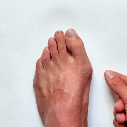 LedFlex™ Knyst – Støttetape til Hallux Valgus