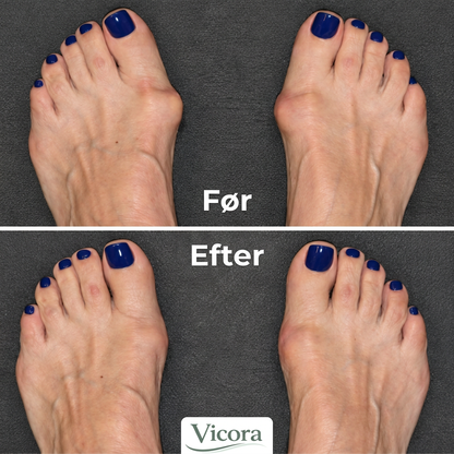 LedFlex™ Knyst – Støttetape til Hallux Valgus
